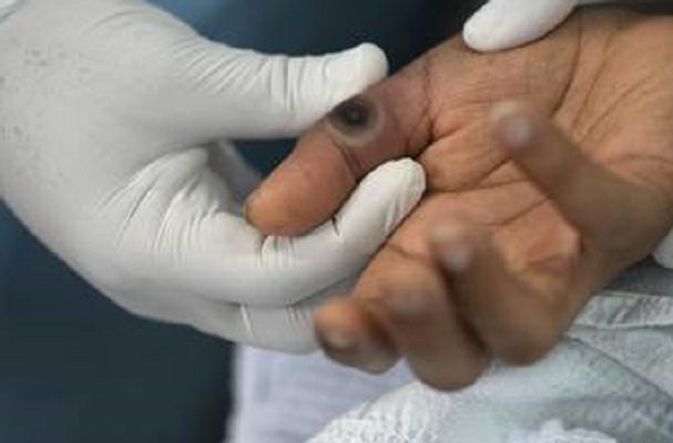 Aguascalientes reporta su primer caso de viruela del mono