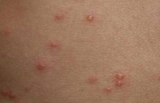 OMS establece acuerdo para traer vacuna contra viruela del mono a América Latina en septiembre