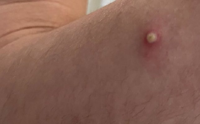 Casos de viruela del mono han disminuido 21% en todo el mundo: OMS