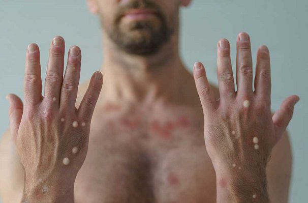 OMS ve signos de retroceso de viruela del mono en Europa