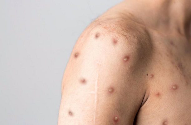 Asciende a 504 el número de casos de viruela del mono en México: Ssa