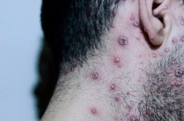 La OMS reporta más de 50 mil casos de viruela del mono a nivel mundial
