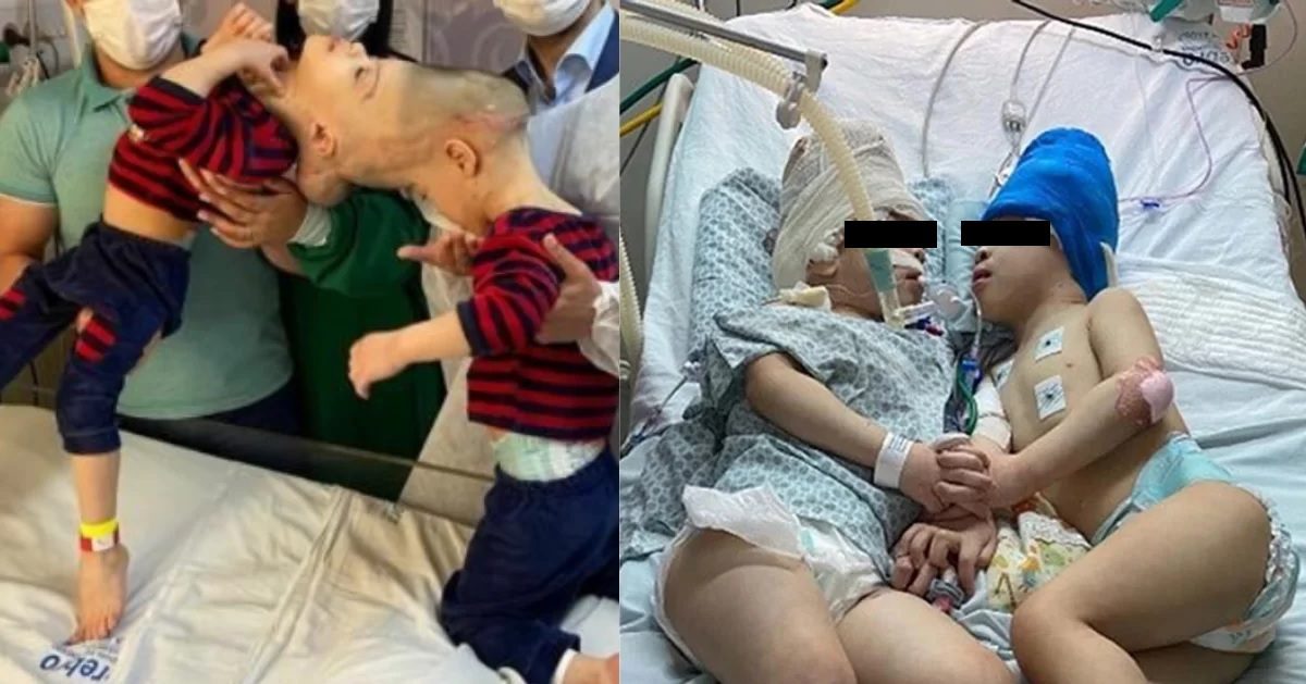 Siameses unidos por la cabeza separados en Brasil