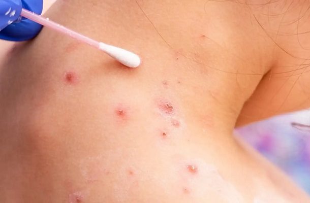 México suma 788 casos de viruela del mono; más de 200 en una semana