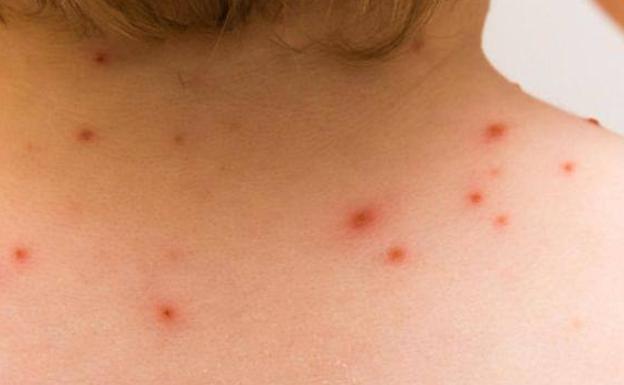 Viruela del mono tiene como epicentro EU, Brasil, Perú y Canadá: OPS