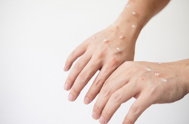 Viruela del mono podría provocar problemas en el corazón, alerta estudio