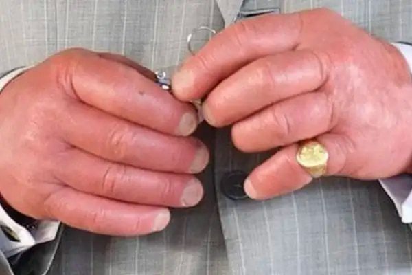 Alarman las manos hinchadas del rey Carlos III por su estado de salud