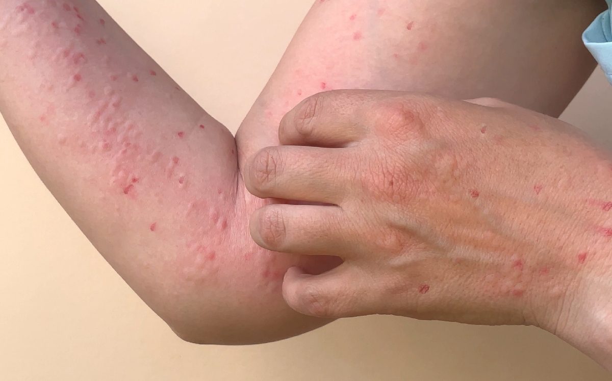 China reporta su primer contagio de viruela del mono