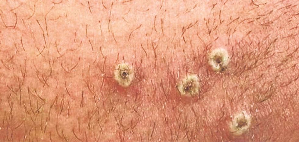 México suma mil 367 casos de viruela del mono: Secretaría de Salud