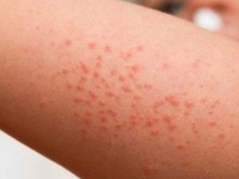 Reportan 4 casos de Coxsackie en Morelos, virus altamente contagioso en menores