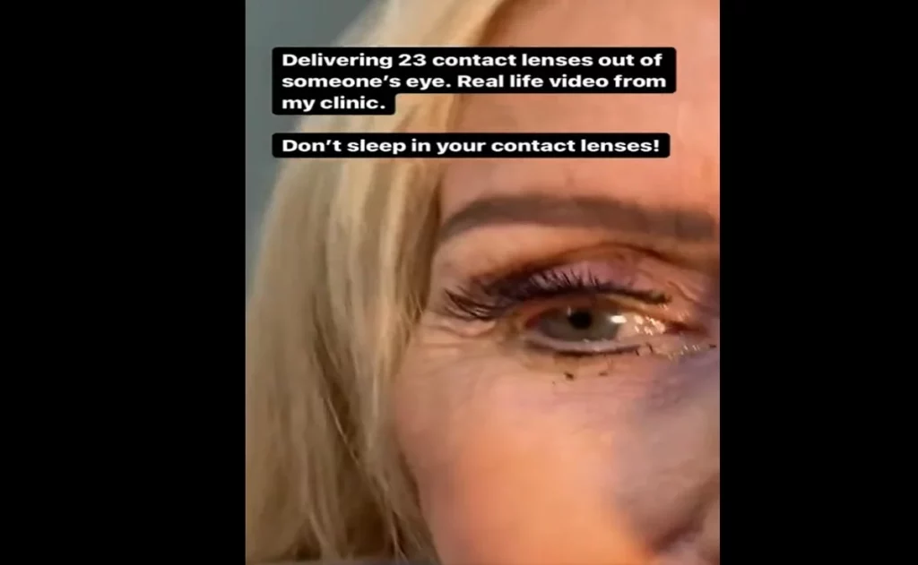 Mujer acude al oftalmólogo y descubren que tiene 23 lentes de contacto puestos #VIDEO