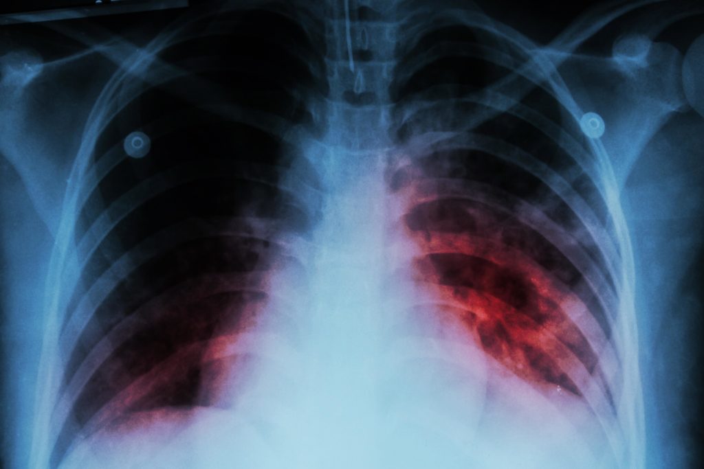 La tuberculosis se está propagando por el mundo nuevamente, advierte OMS