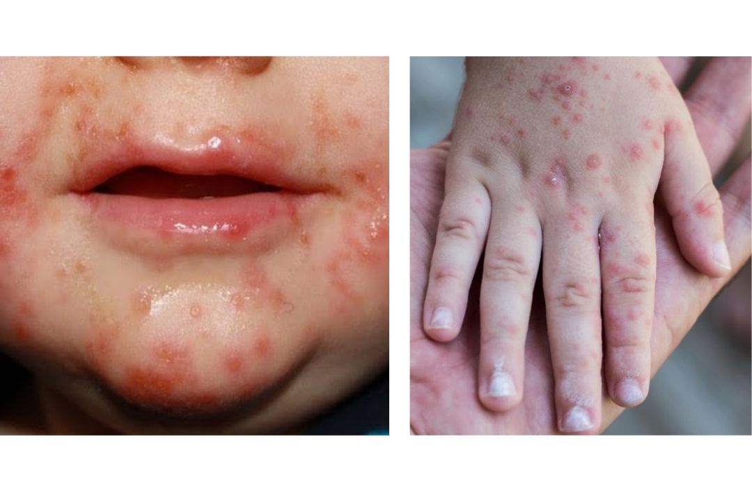 Se registra brote del virus coxsackie en una primaria de Tlaxcala