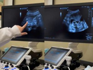 Estudiantes se hacen práctica de ultrasonido y revelan embarazo #VIDEO