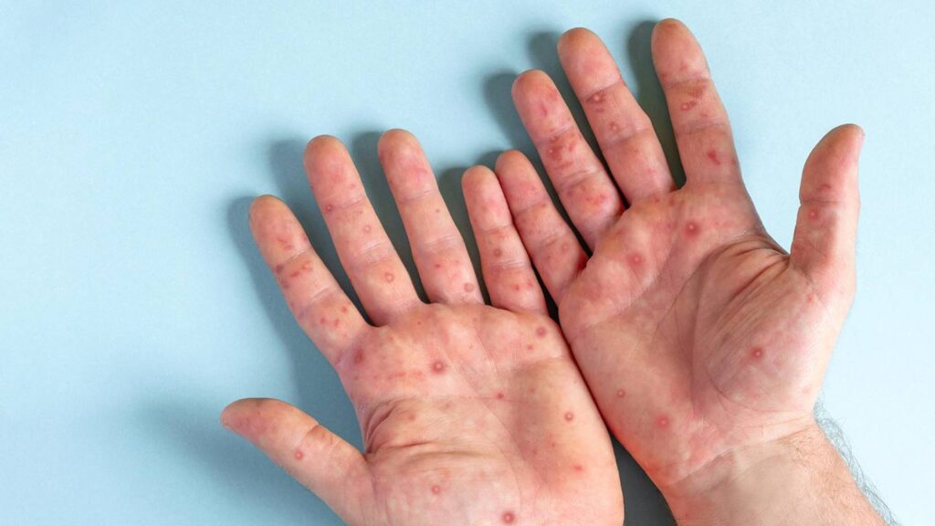 Viruela del mono en México