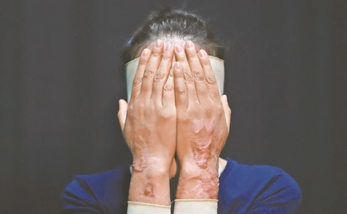 Senado avala dar hasta 21 años de cárcel a quienes ataquen con ácido a mujeres