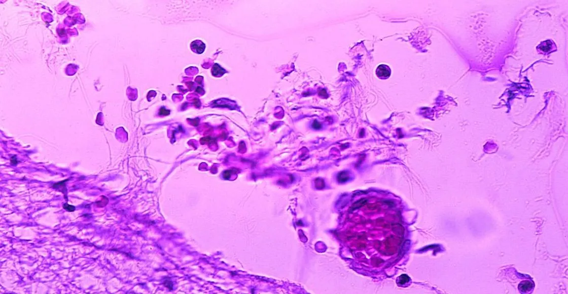 Suman 9 muertes y 61 contagios por meningitis aséptica en Durango