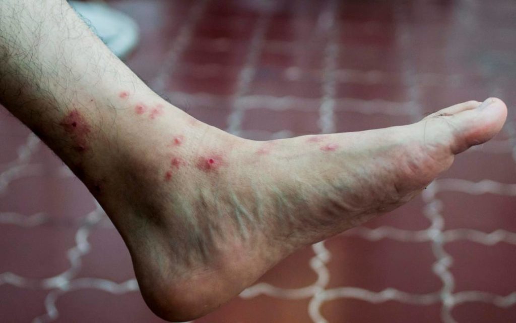 México registra 10 defunciones y 3 mil 145 contagios de viruela del mono