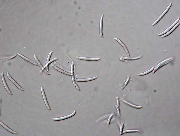 Suman 19 muertas y 68 contagios de meningitis aséptica en Durango