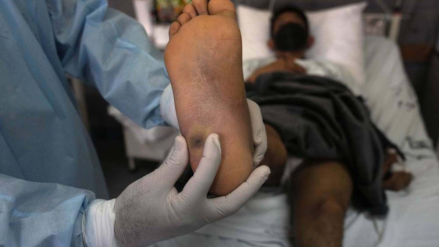 México reporta 128 nuevos casos de viruela del mono