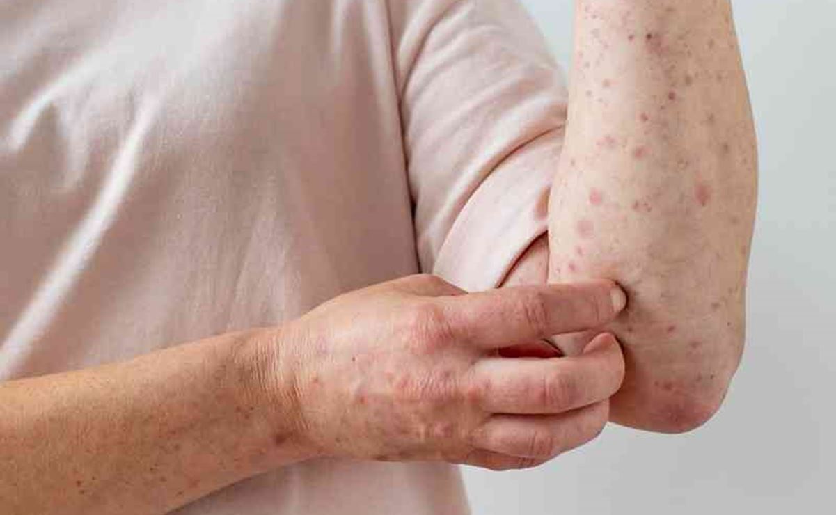 Viruela del mono en México