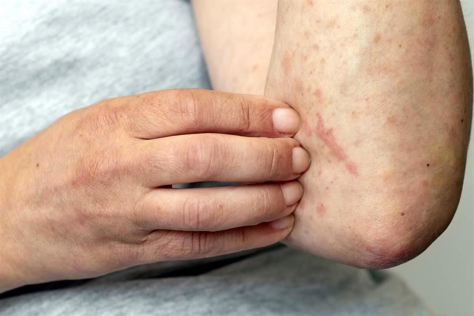 Viruela del mono en México