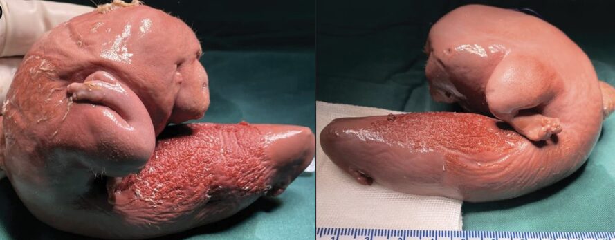 Encuentran el feto de su hermano dentro del cerebro de niña