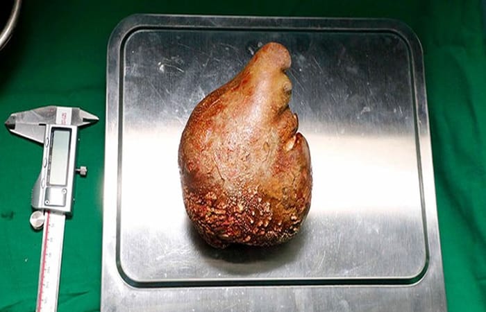 Médicos de Sri Lanka extirpan el cálculo renal más grande del mundo