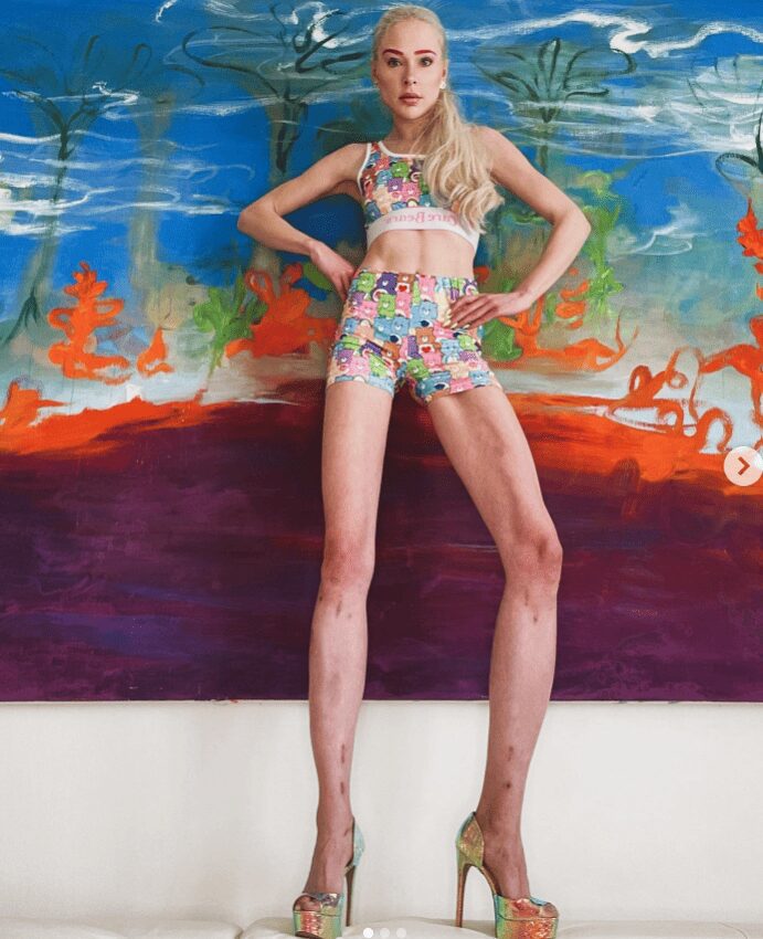 Una modelo se somete a cirugía en las piernas para aumentar su altura, después de que su expareja le hiciera tal petición