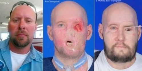 En Estados Unidos, médicos logran por primera vez realizar un trasplante de ojo completo