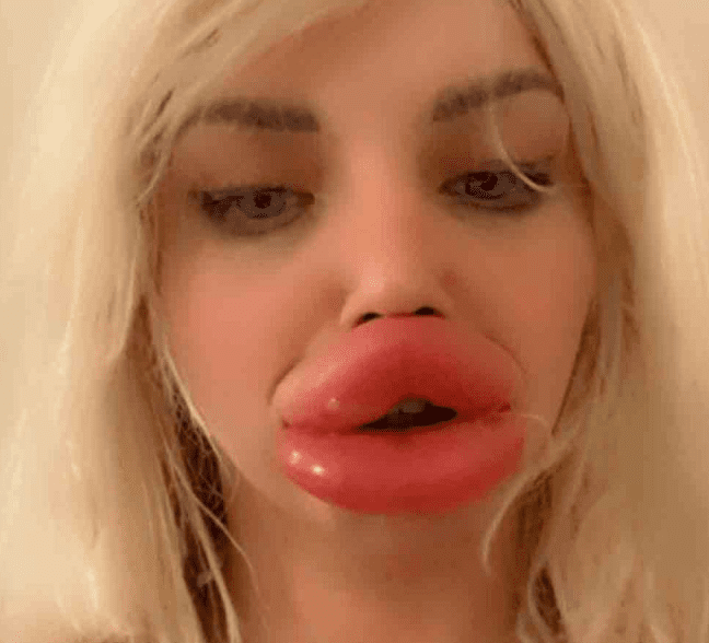 Influencer con labios enormes, confiesa que no puede comer ni beber