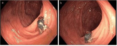 Médicos encuentran mosca viva en intestino de paciente