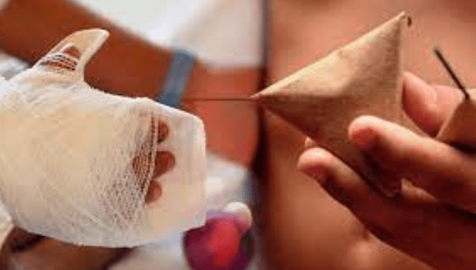 Niño sufre explosión de cohete, resultando en amputación de dos dedos