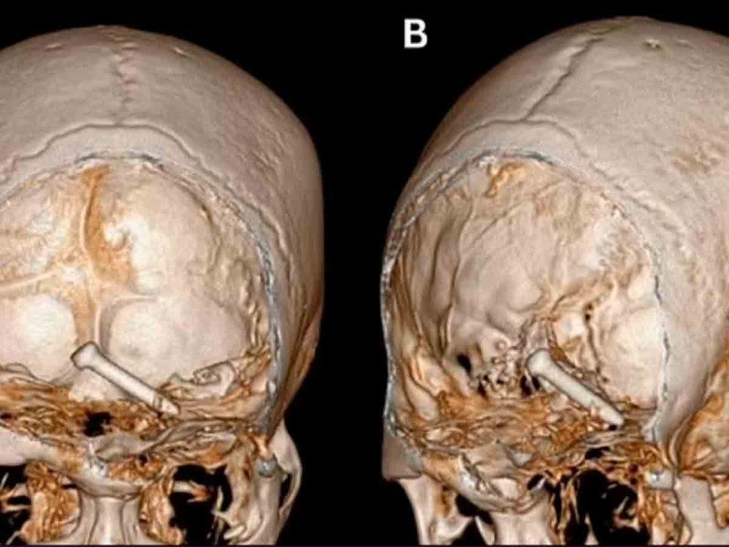 Hombre se dispara en un ojo con una pistola de clavos averiada y sobrevive