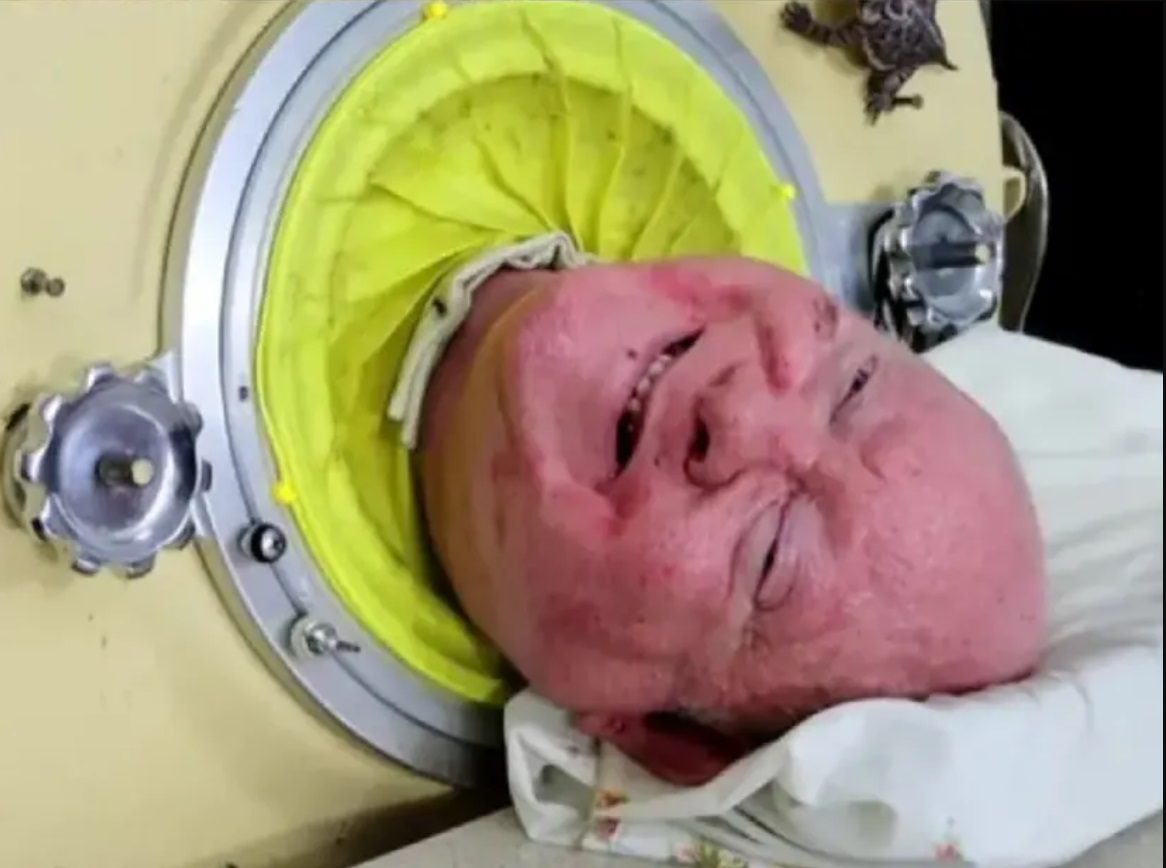 Paul Alexander, quien vivió 70 años con asistencia respiratoria, falleció