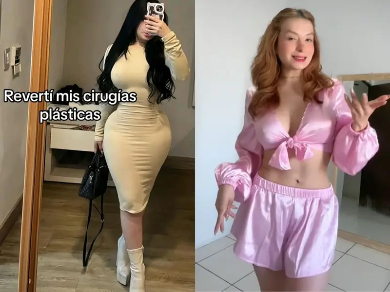 Mujer se retirar implantes estéticos: “Me quité el cuerpo de buchona”