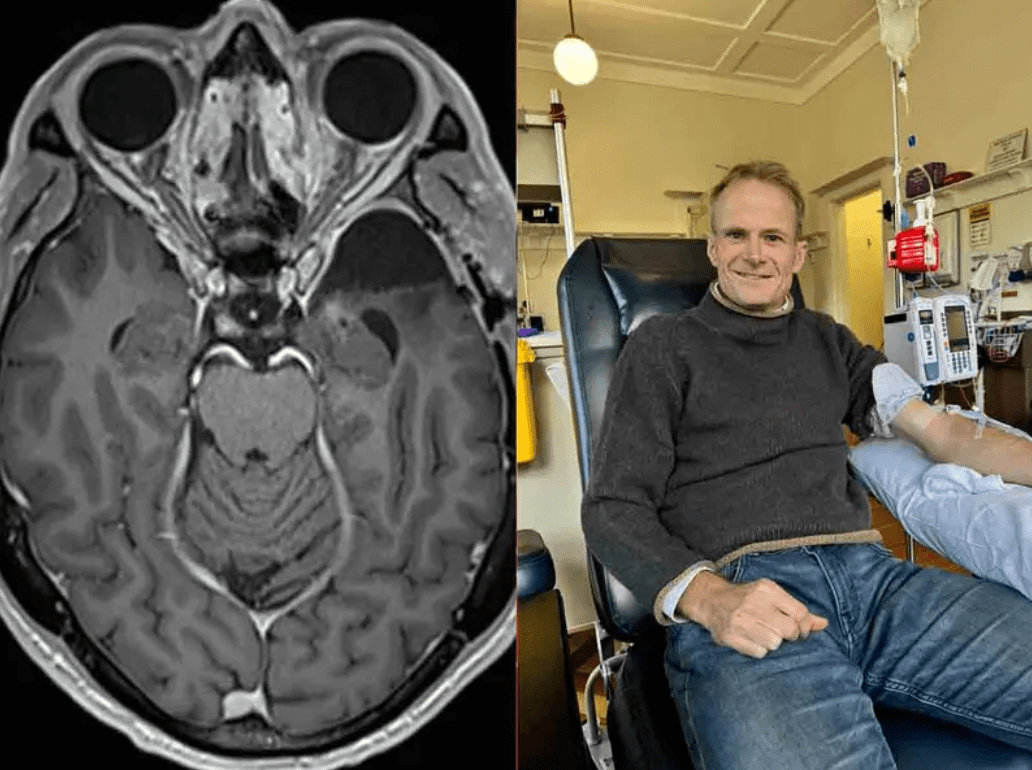 Médico se cura de cáncer cerebral terminal con  tratamiento revolucionario