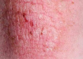 Advierten sobre una nueva ETS por hongos muy contagiosa