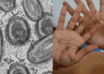 Suman 29 casos de Viruela del Mono en la Ciudad de México