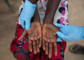 Autoridades europeas instan a prepararse para más casos de viruela del mono