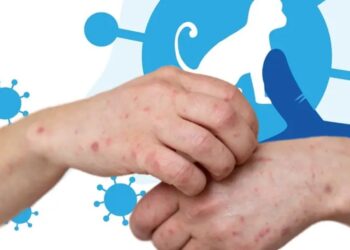 Tlaxcala confirma su primer caso de viruela del mono del año 2024