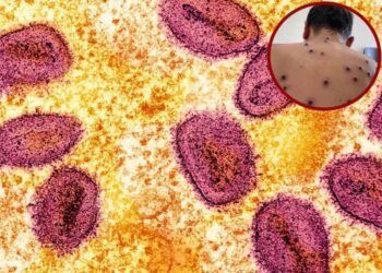 Estos estados han registrado casos de viruela del mono