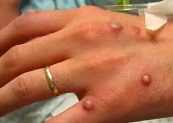 En Nayarit, primer caso de viruela del mono se retira en transporte público