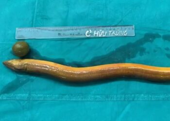 Un sujeto se metió una anguila viva en el trasero y tuvo que ser operado