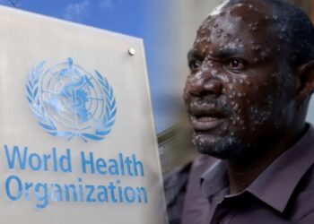 La OMS declara emergencia global por brote de viruela del mono