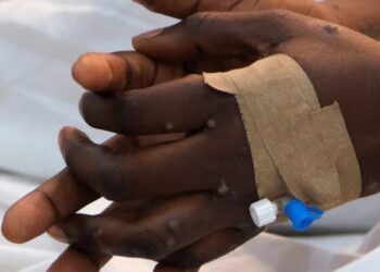 Se reportaron seis nuevos casos de viruela del mono en México en la última semana