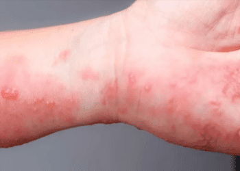 Se han detectado más de 2 mil casos de viruela símica en CDMX