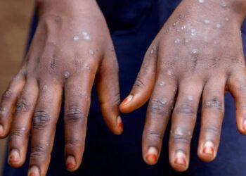 Alemania confirma su primer caso de la variante más letal de la viruela del mono