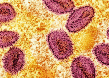 África en crisis por más de 50 mil contagios de viruela del mono