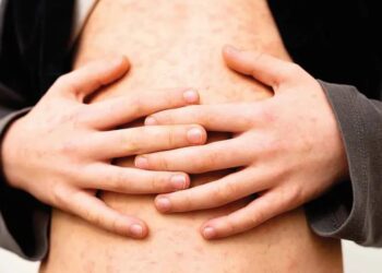 Aumentan casos de sarampión; vacunación al 70%